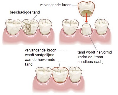 Relatie meest Opsommen Kronen – Tandartsenpraktijk Stadshart